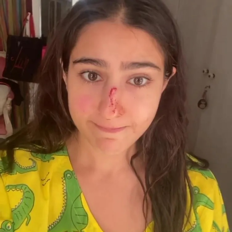 Sara Ali Khan शूटिंग के दौरान हुईं घायल, नाक पर लगी चोट Sara Ali Khan शूटिंग के दौरान हुईं घायल, नाक पर लगी चोट